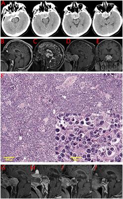 Coexistence of Pituitary Adenoma and Primary Pituitary Lymphoma: A Case Report and Review of the Literature